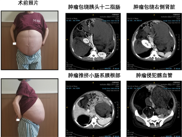 女子回国求医医生历经5小时切除其腹腔重达25公斤肿瘤